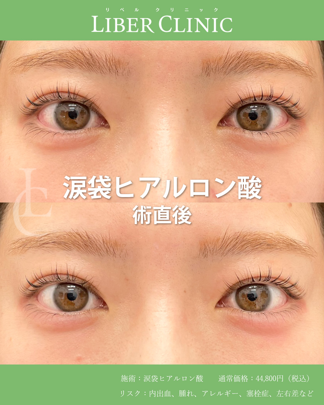 自然にたれ目に涙袋ヒアルロン酸