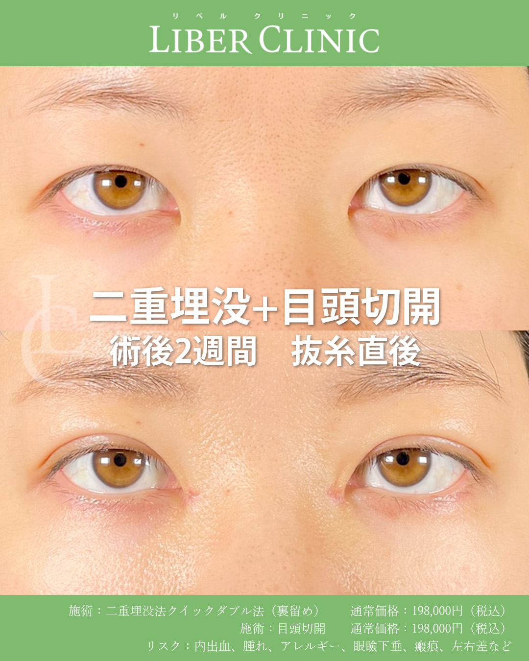 手術前と術後2週間抜糸直後