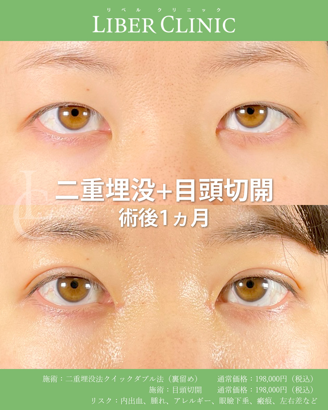 手術前と術後1ヵ月