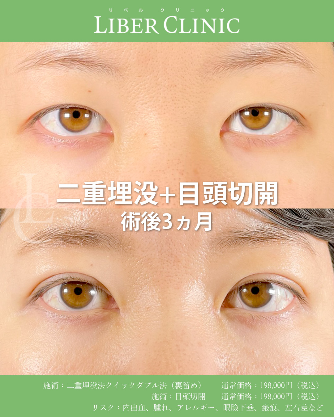 二重埋没+目頭切開で上品な目元へ