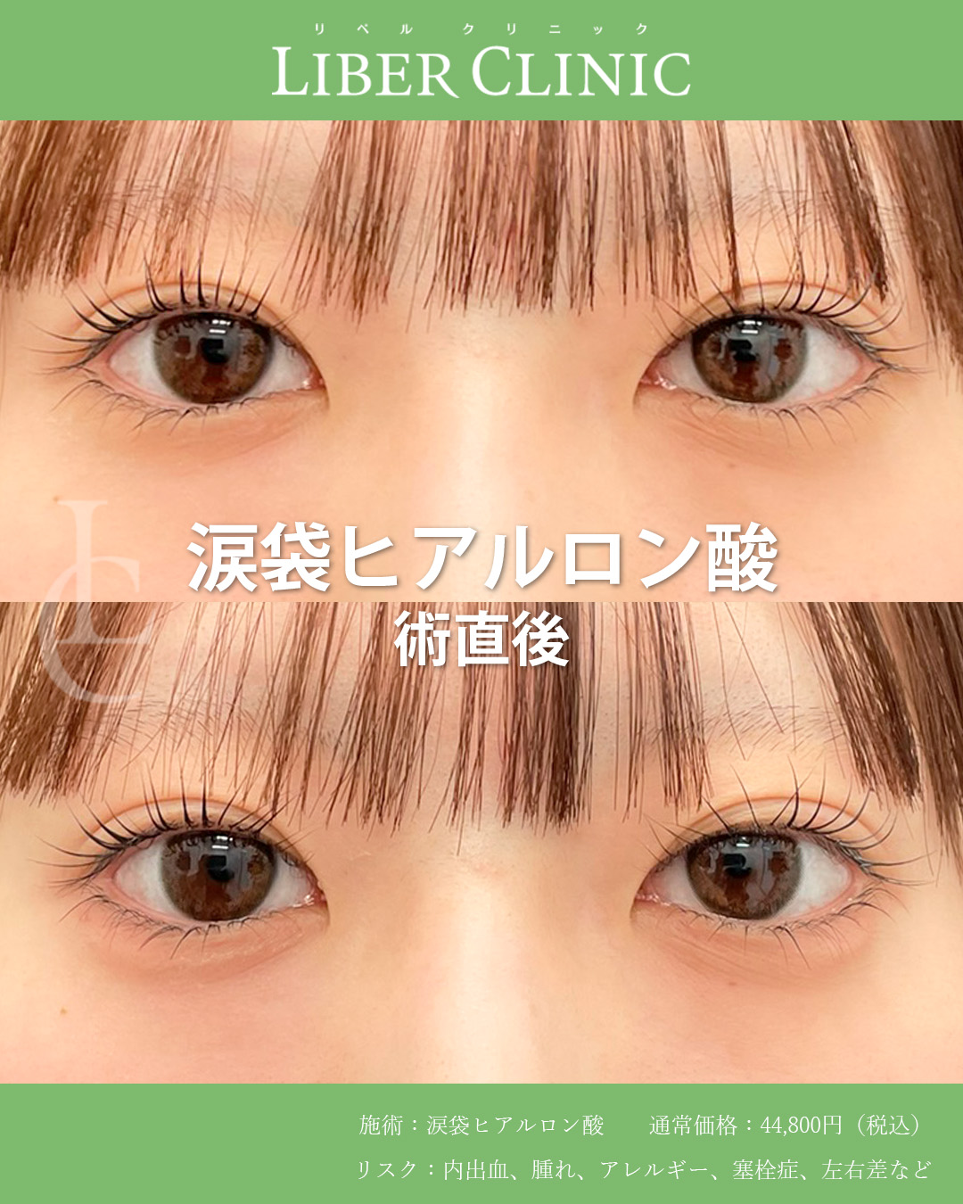 自然にうるっと見える涙袋へ