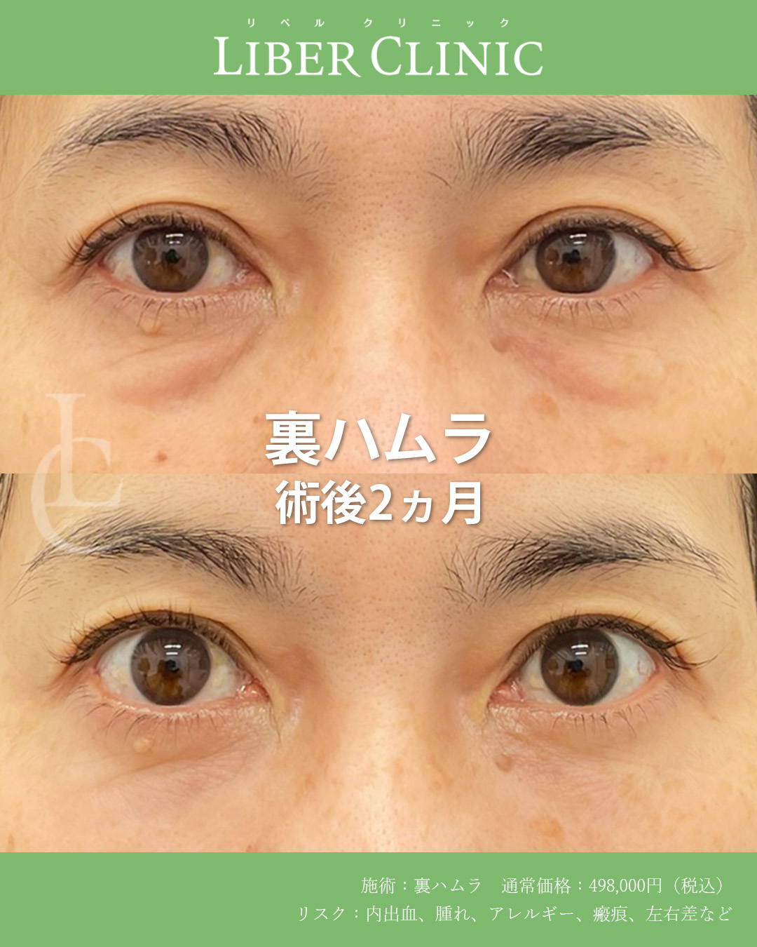 靭帯の食い込みを解消フラットな目元へ