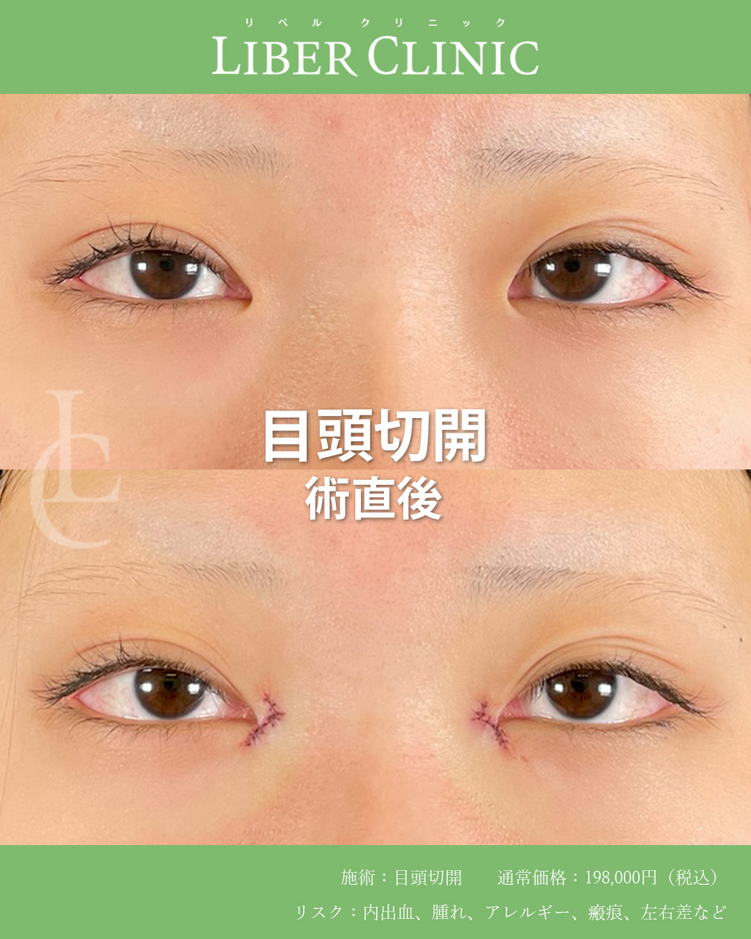 手術前と術直後