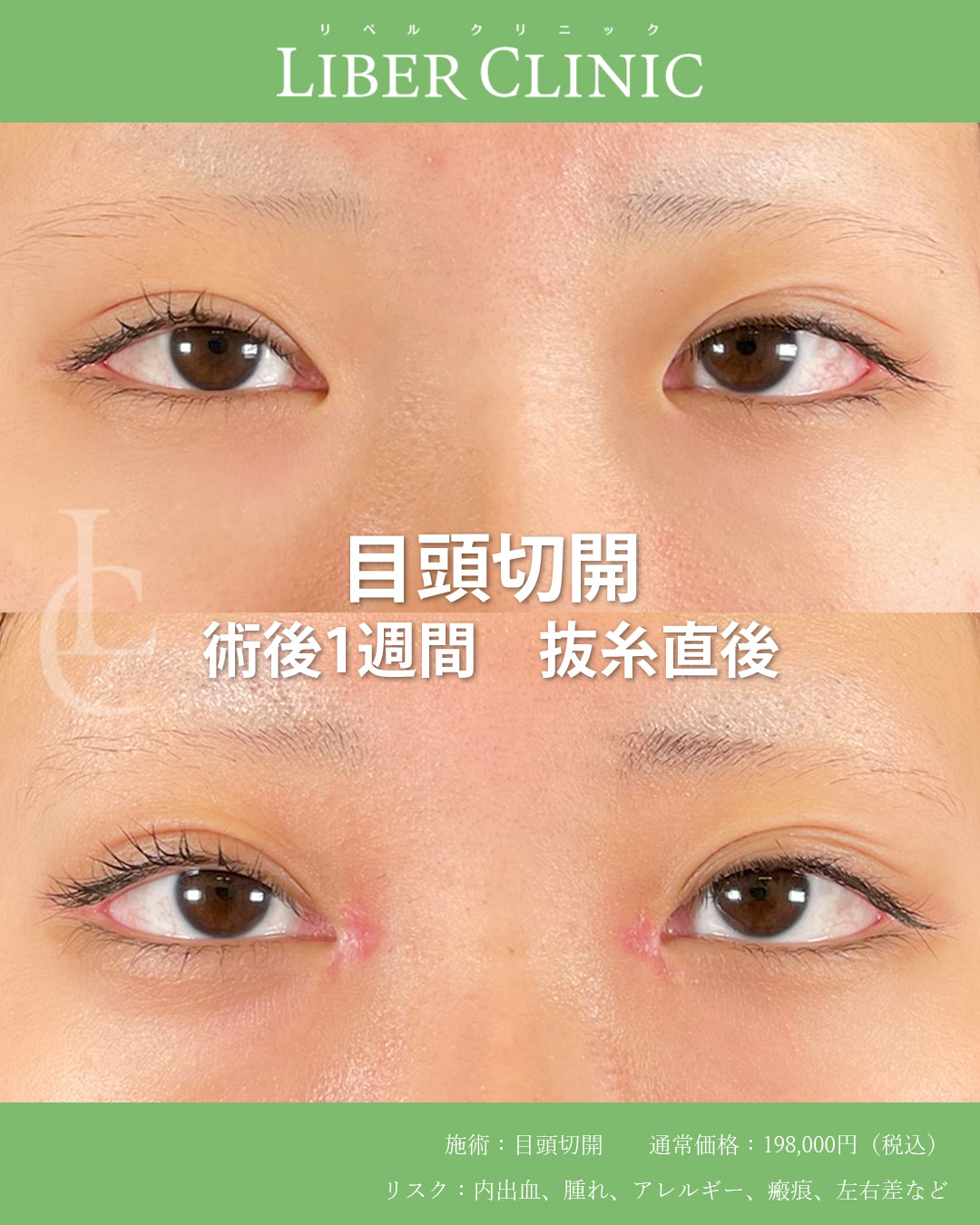 手術前と術後1週間抜糸直後