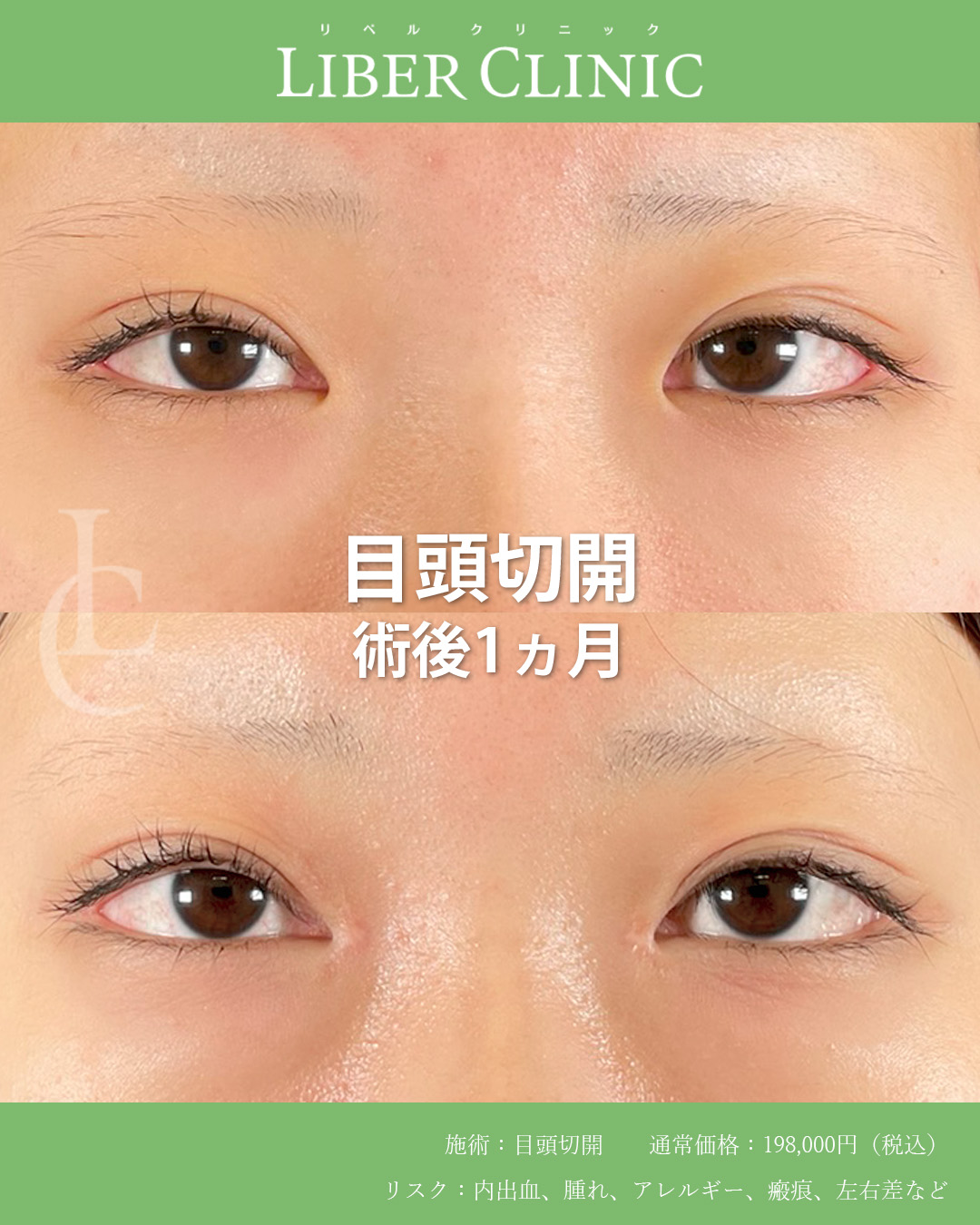 手術前と術後1ヵ月