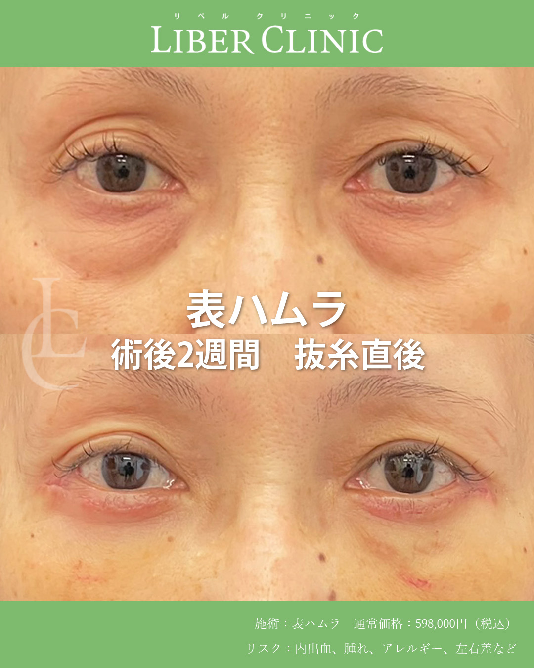 手術前と術後2週間