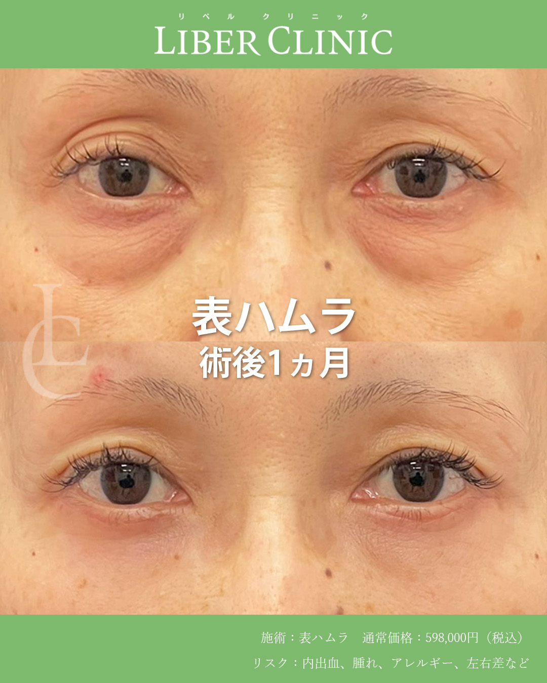 手術前と術後1ヵ月