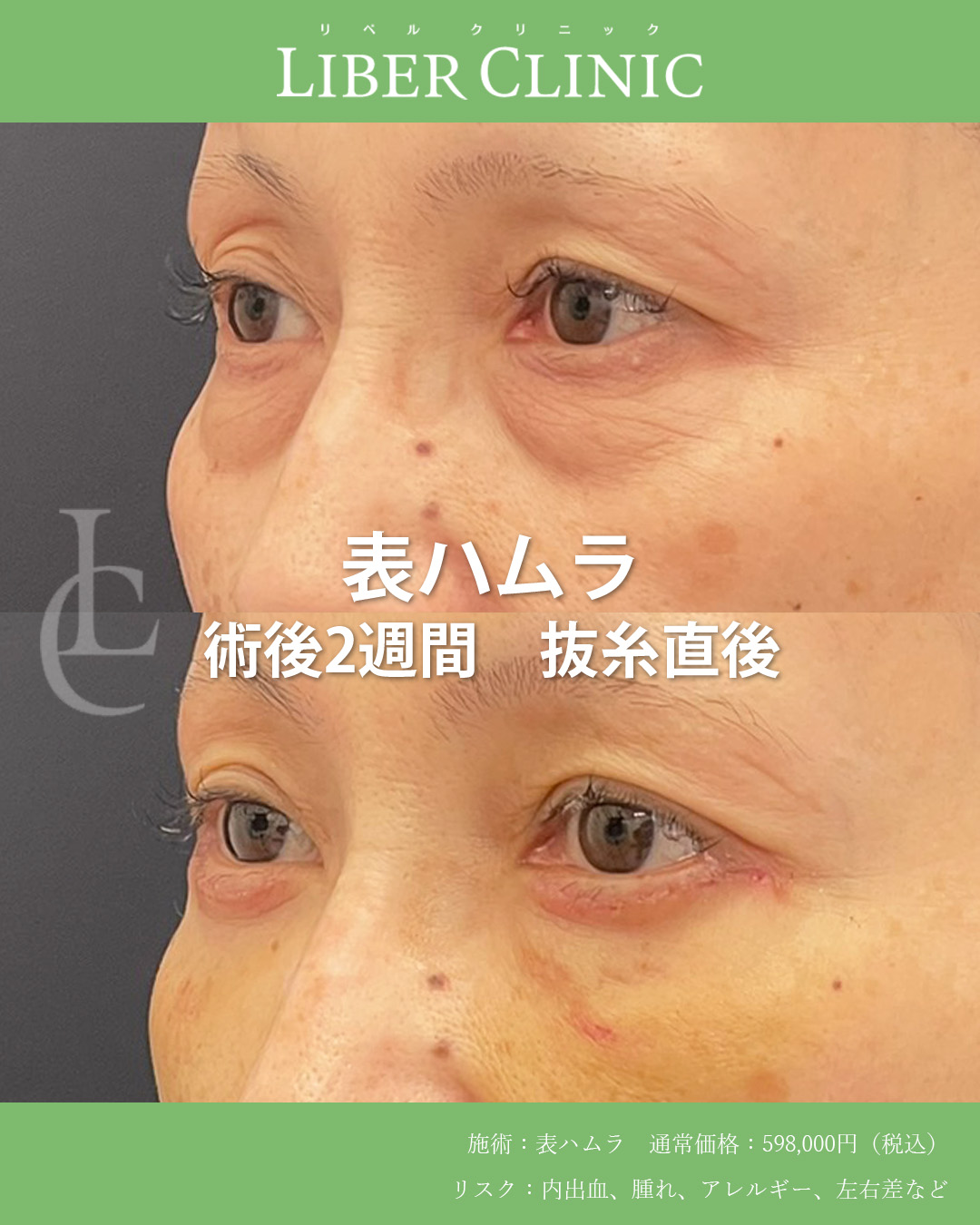 手術前と術後2週間