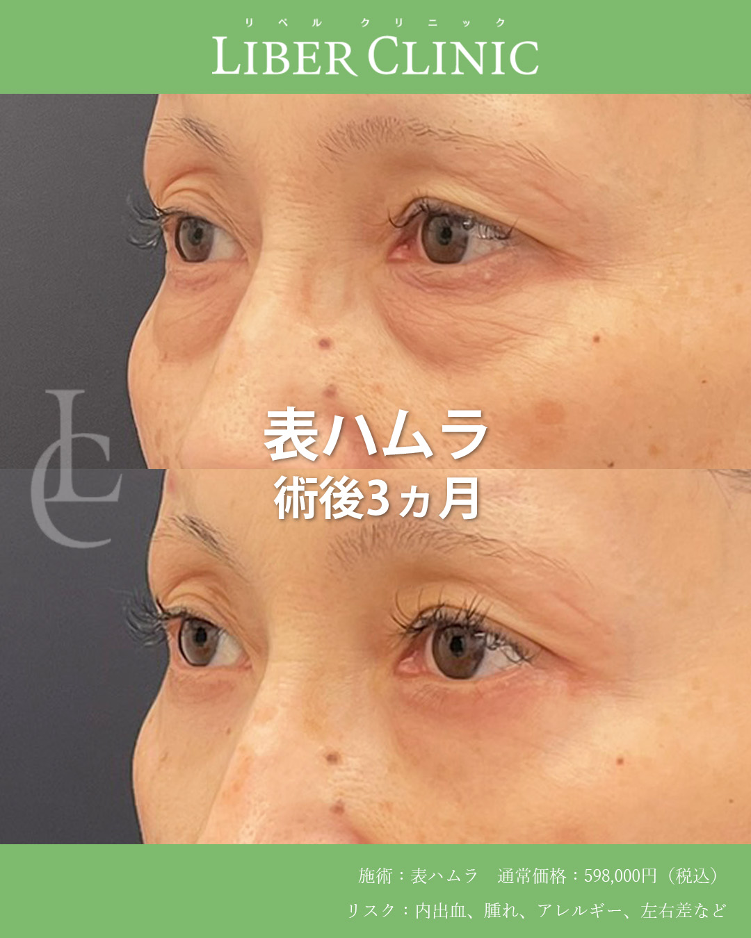 手術前と術後3ヵ月