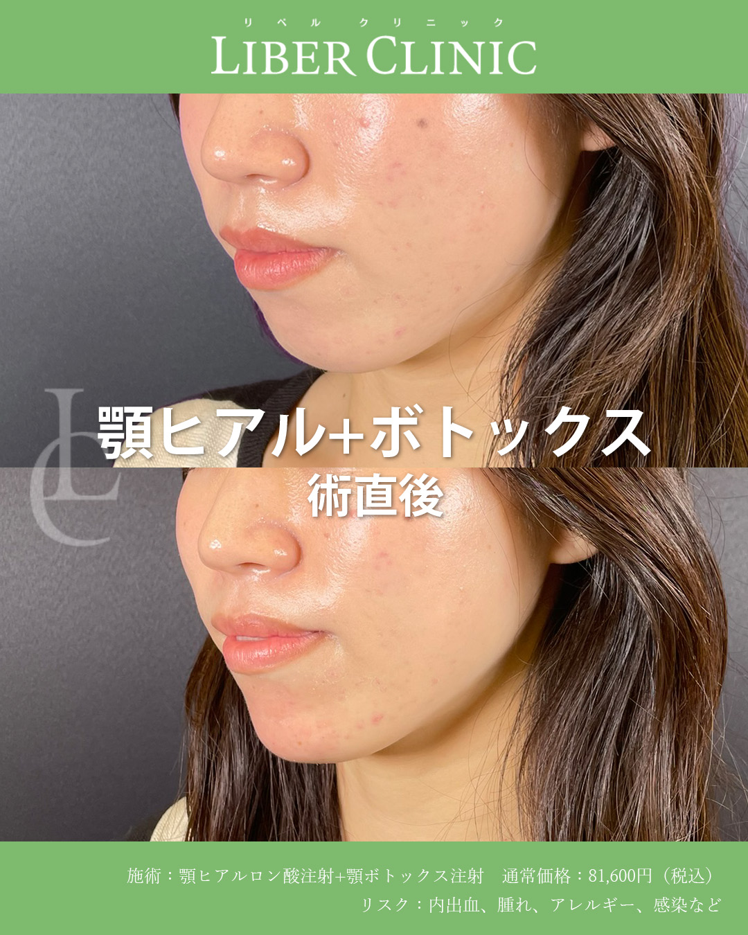 手術前と術直後