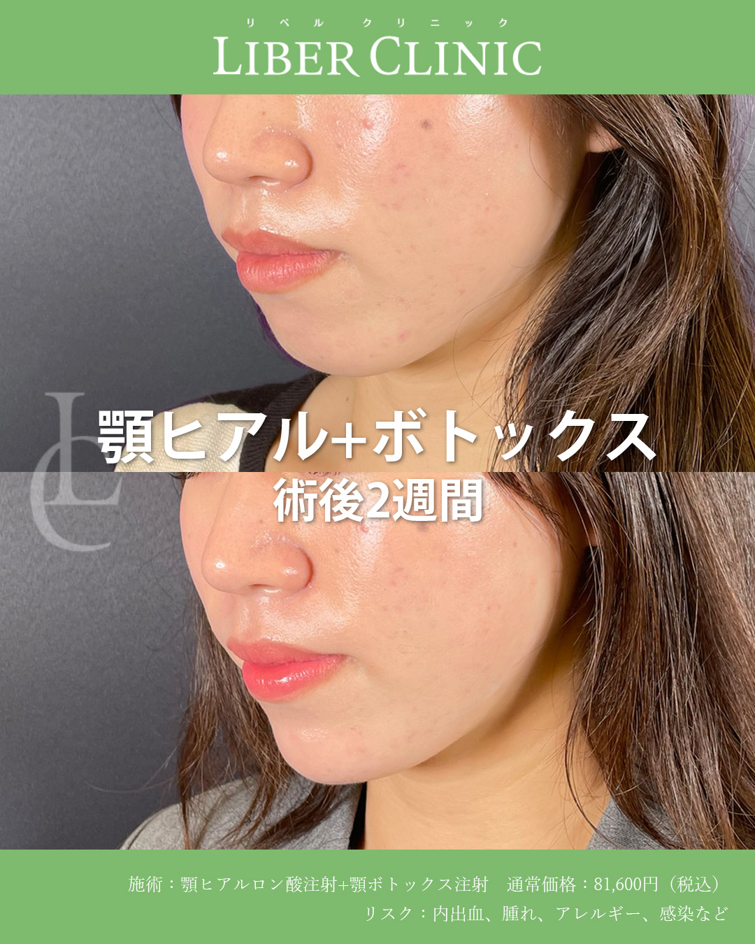 顎ヒアル＆ボトックスで口元のバランスを整える