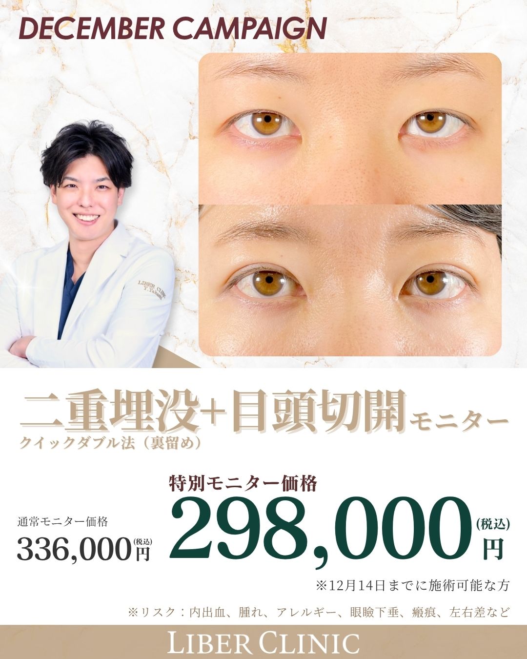 二重埋没+目頭切開｜モニター