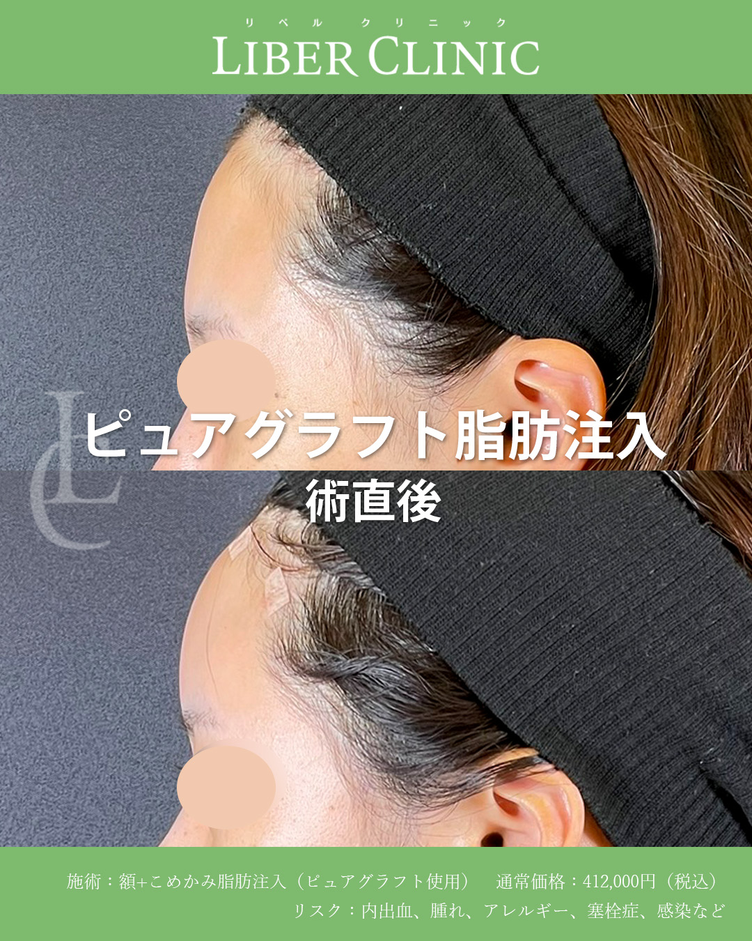 手術前と術直後