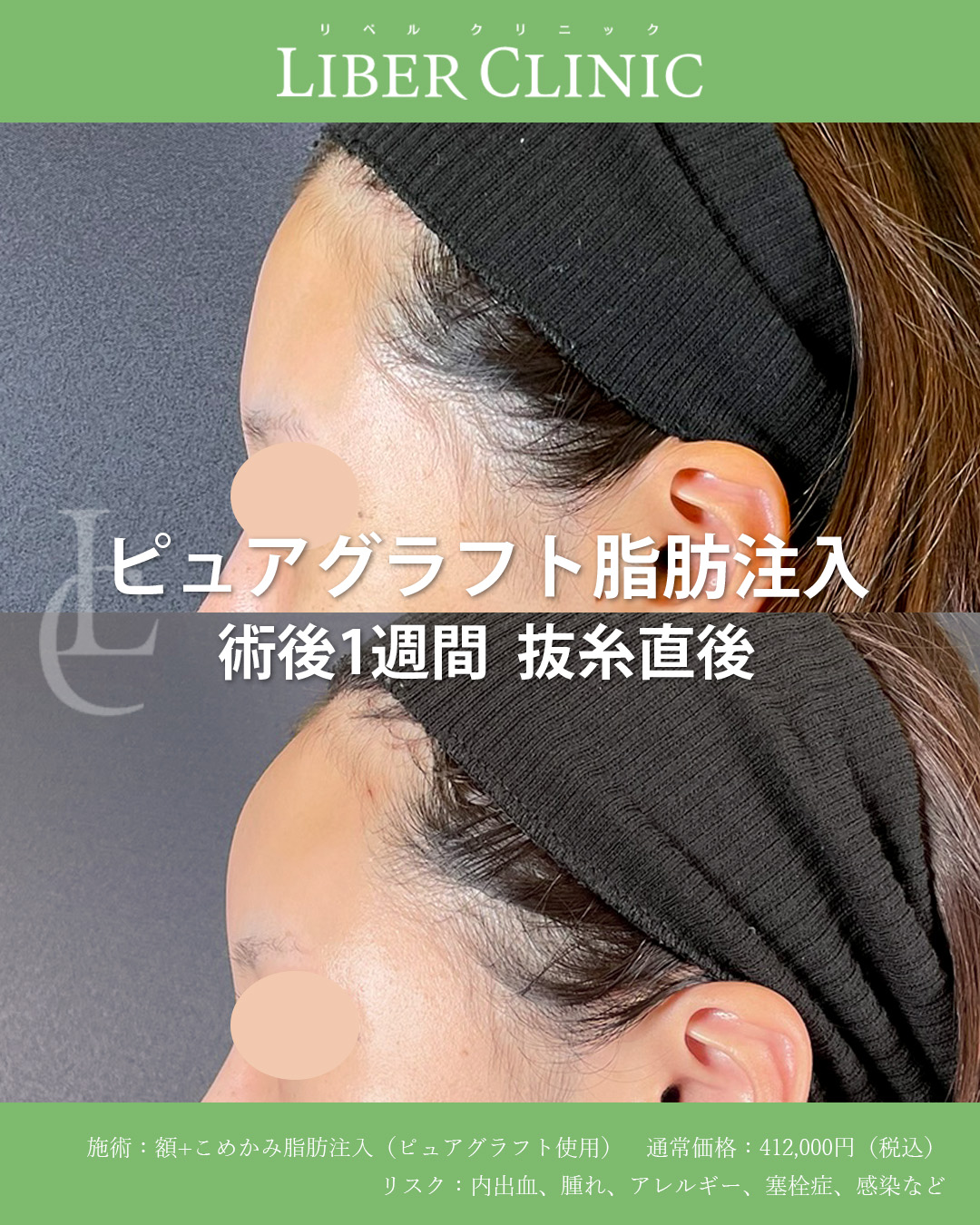 手術前と術後1週間