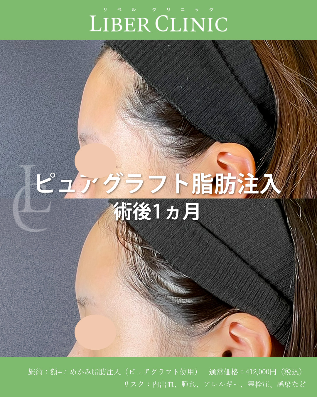 手術前と術後1ヵ月