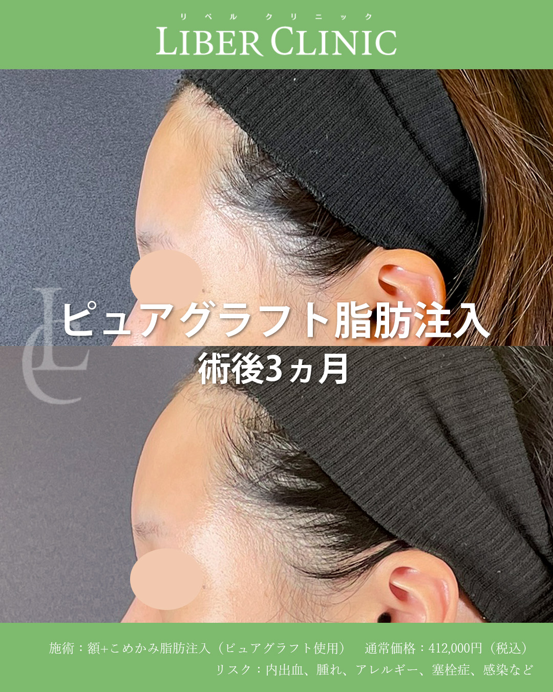 自然な丸みだけを足すピュアグラフト脂肪注入