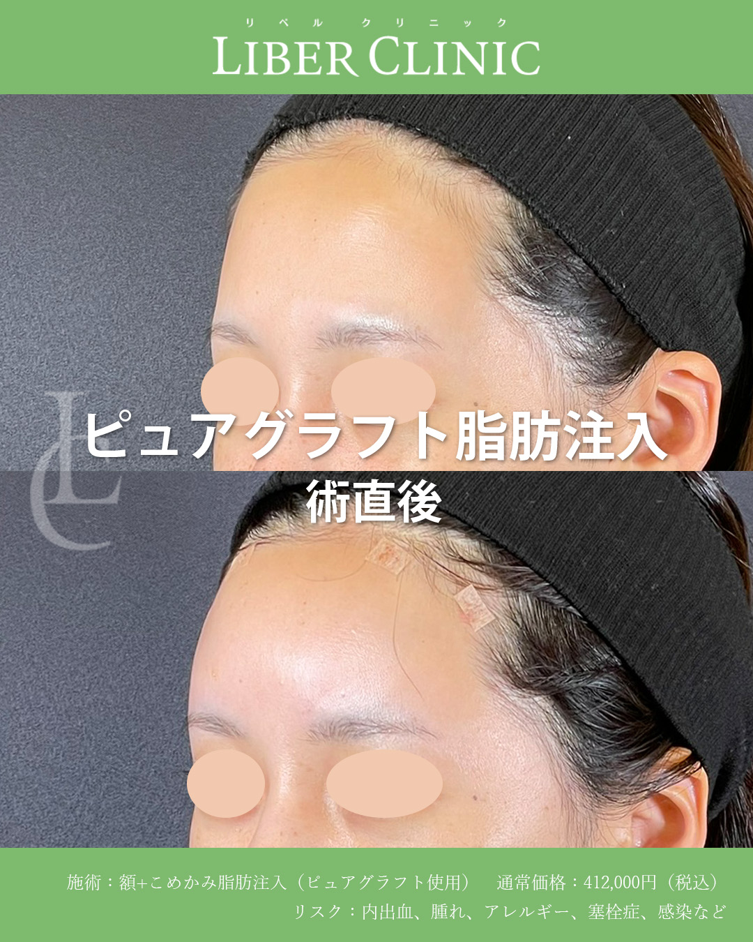 手術前と術直後