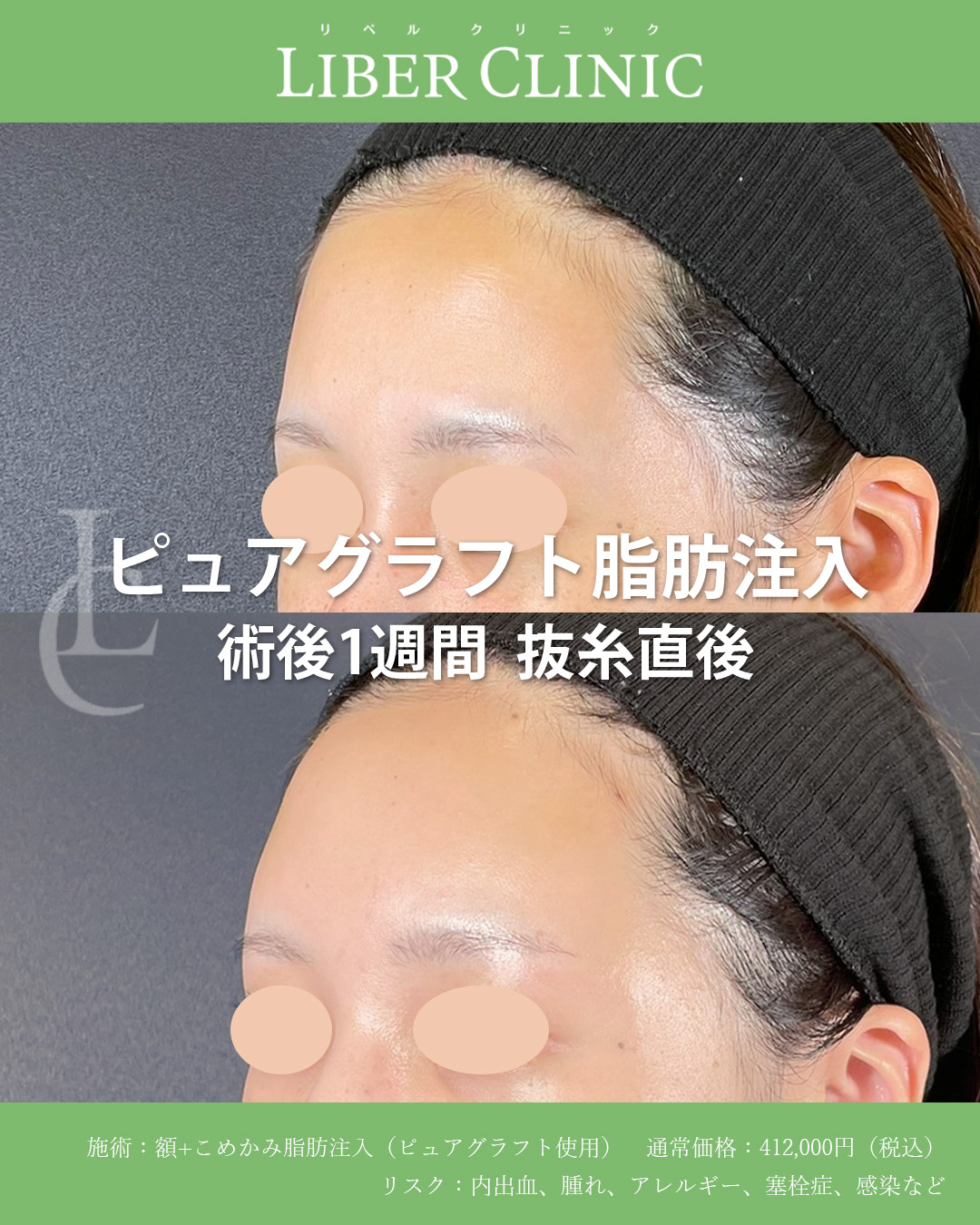 手術前と術後1週間