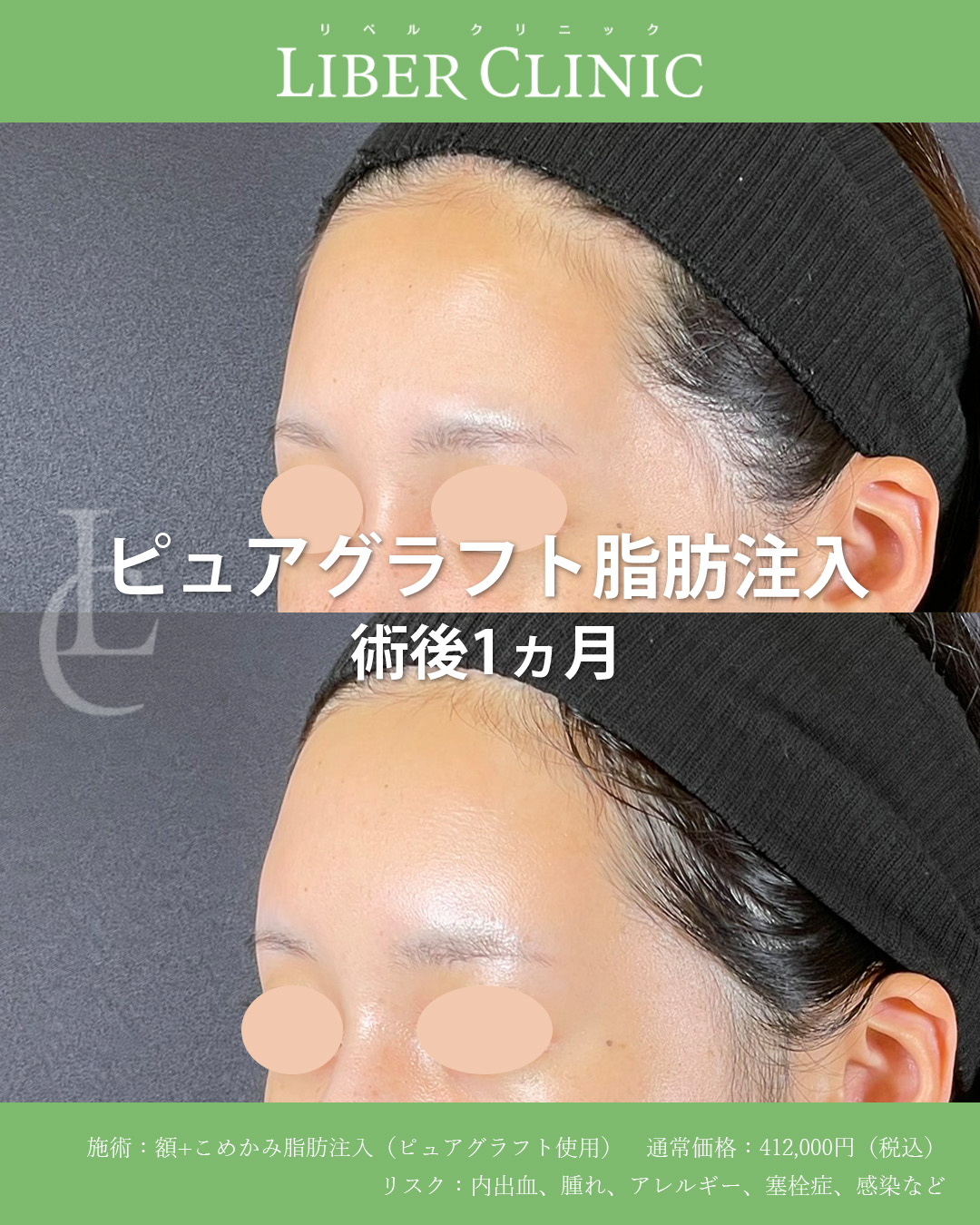 手術前と術後1ヵ月