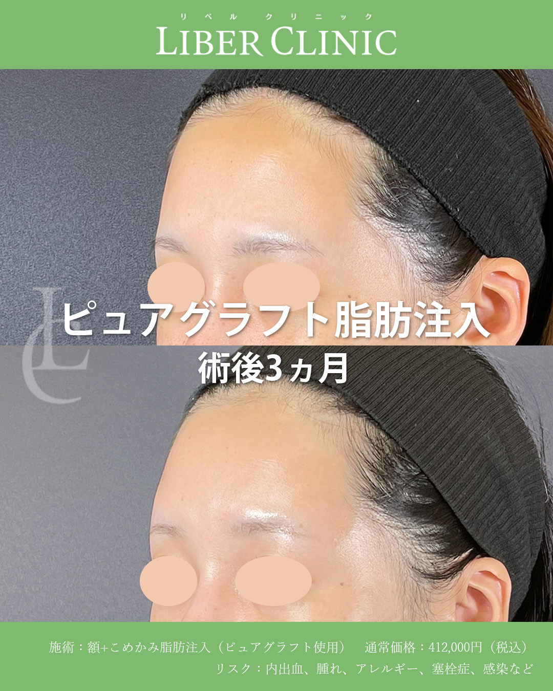 手術前と術後3ヵ月