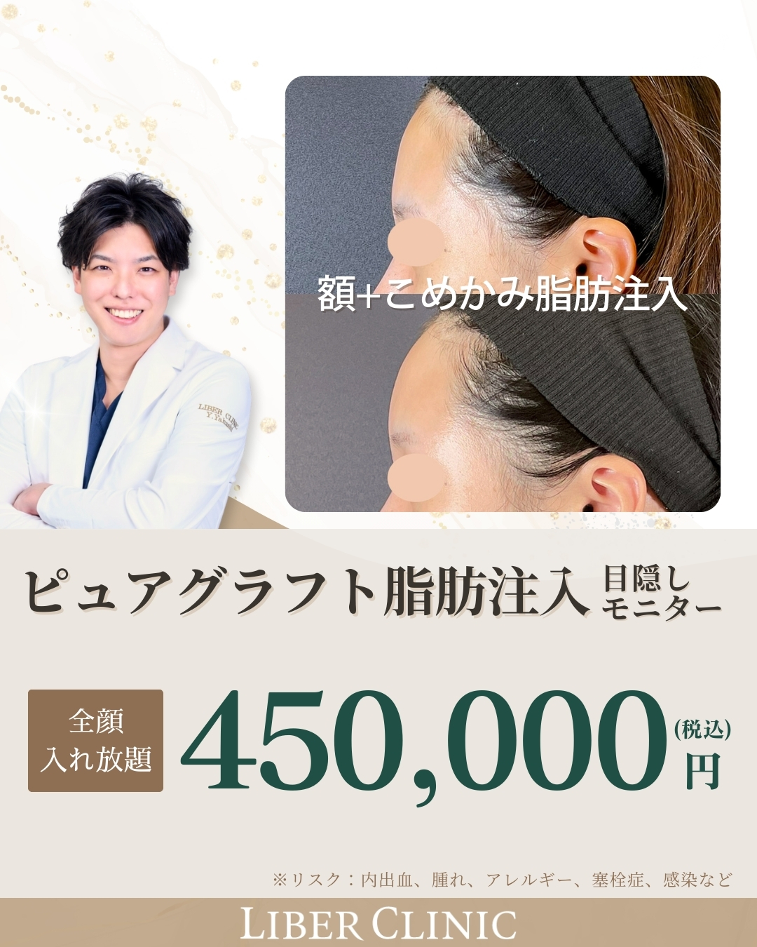 1月のおすすめ施術_ピュアグラフト脂肪注入