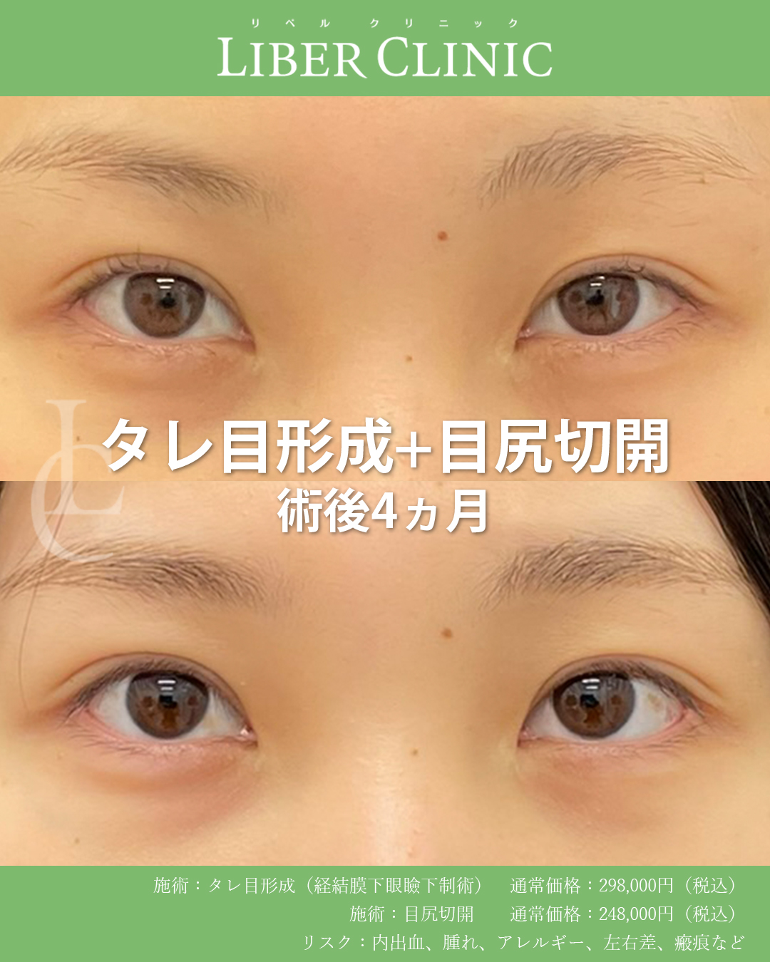 タレ目尻で左右差を整える