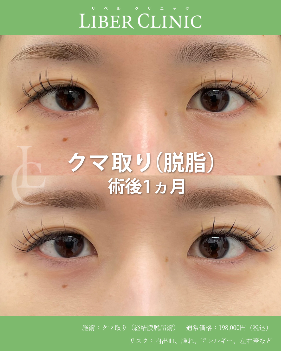 クマは要らない涙袋は欲しい