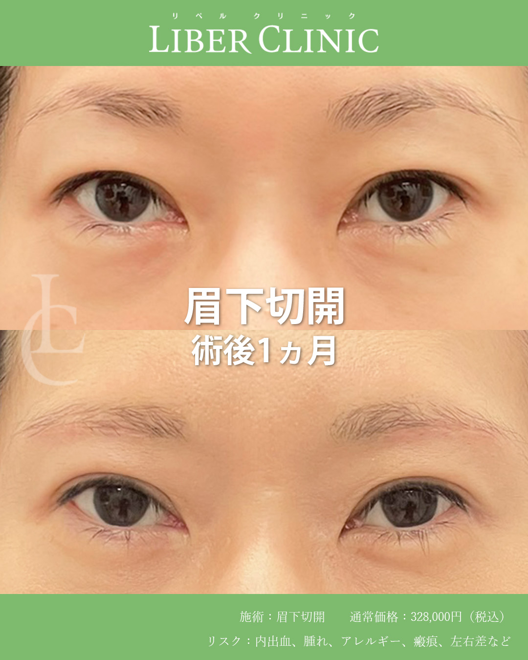 まぶたの重さを自然にリセットする眉下切開