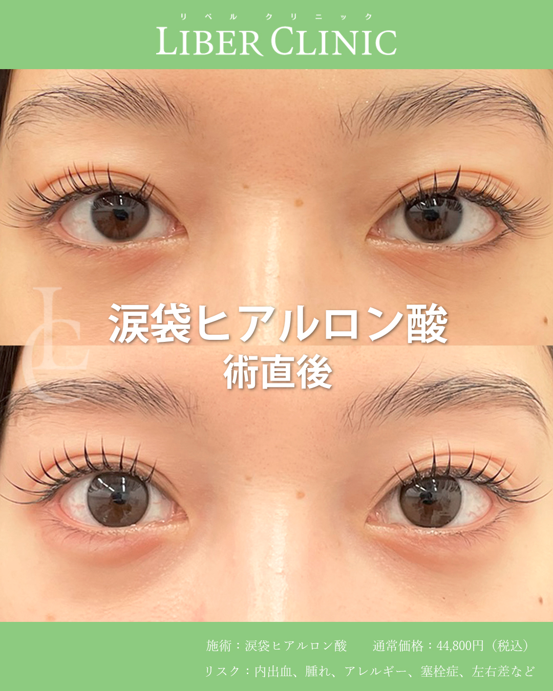 わたしだけのオーダーメイド涙袋