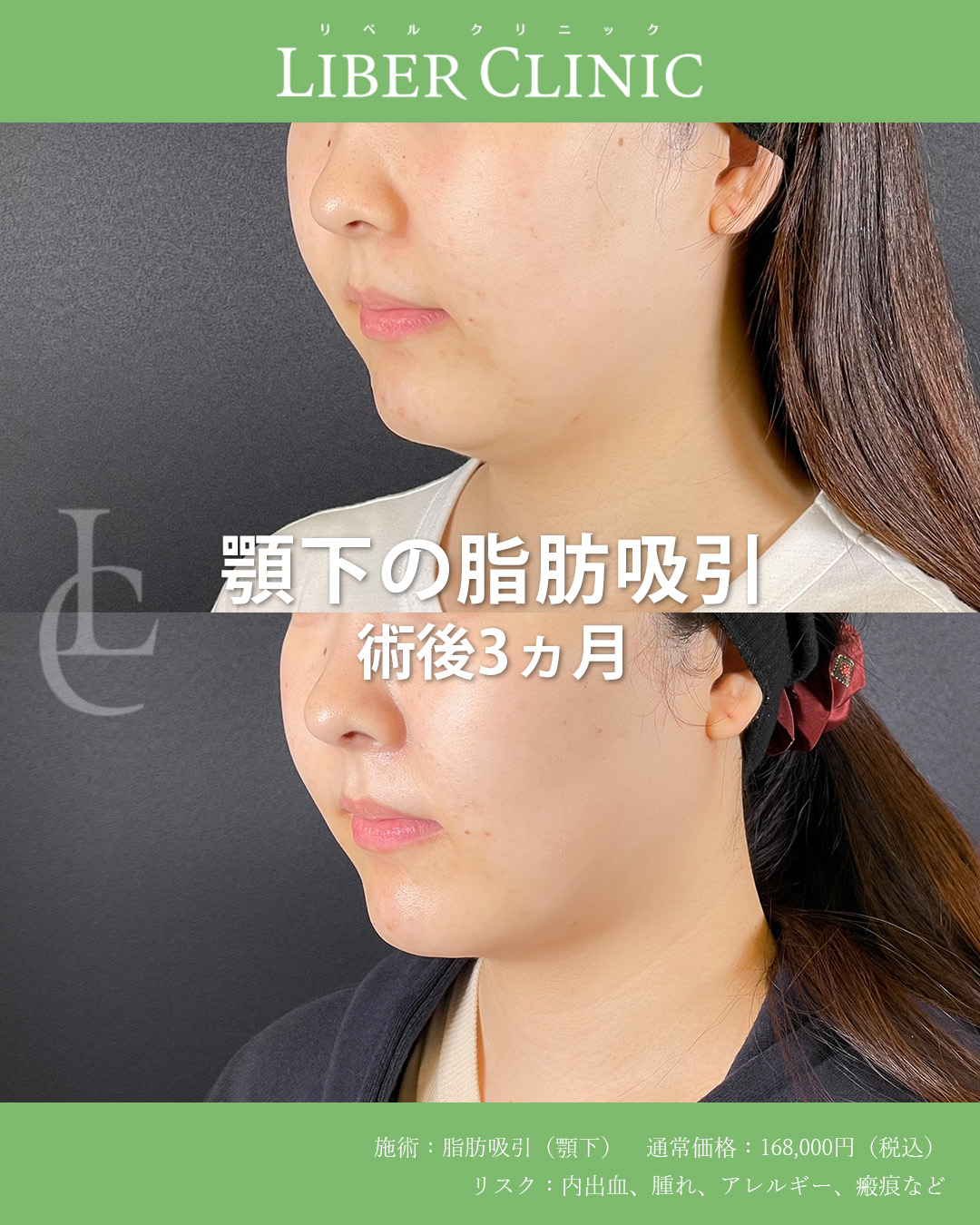 顎下の脂肪吸引術後3ヵ月