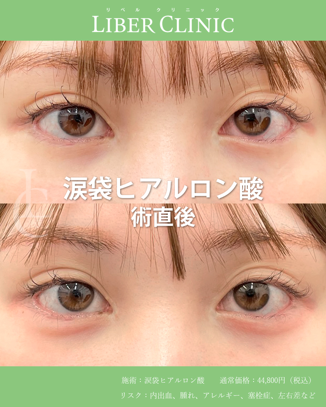 切開後でも涙袋は諦めなくていい