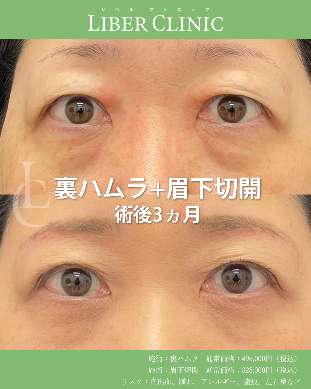 上下のまぶたを同時に整えて明るい目元へ