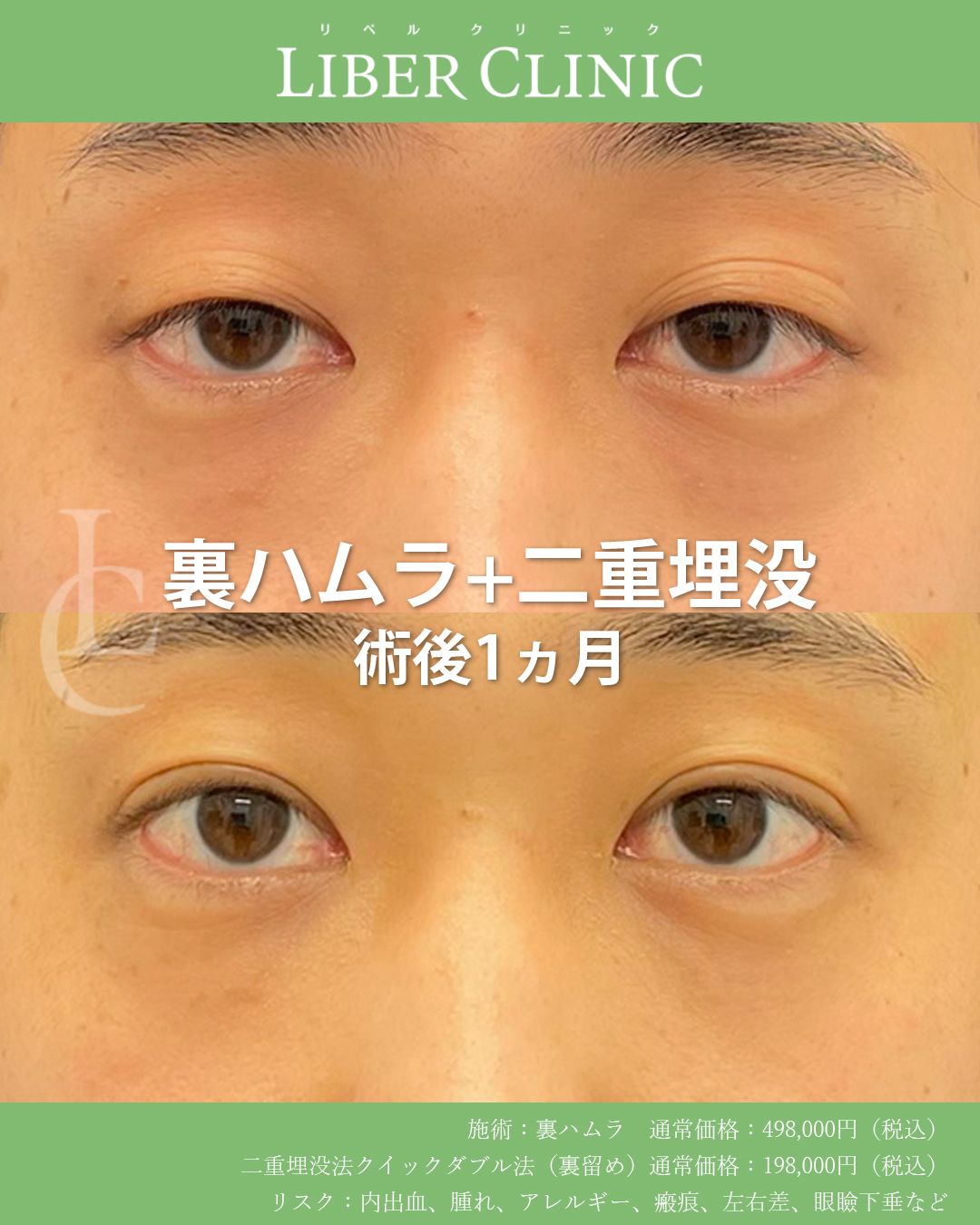 メンズの目元整形も #やっぱりやはし