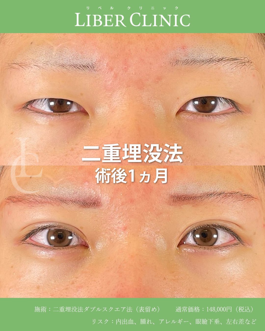 こだわりのデザインでメンズメイクが映える二重へ