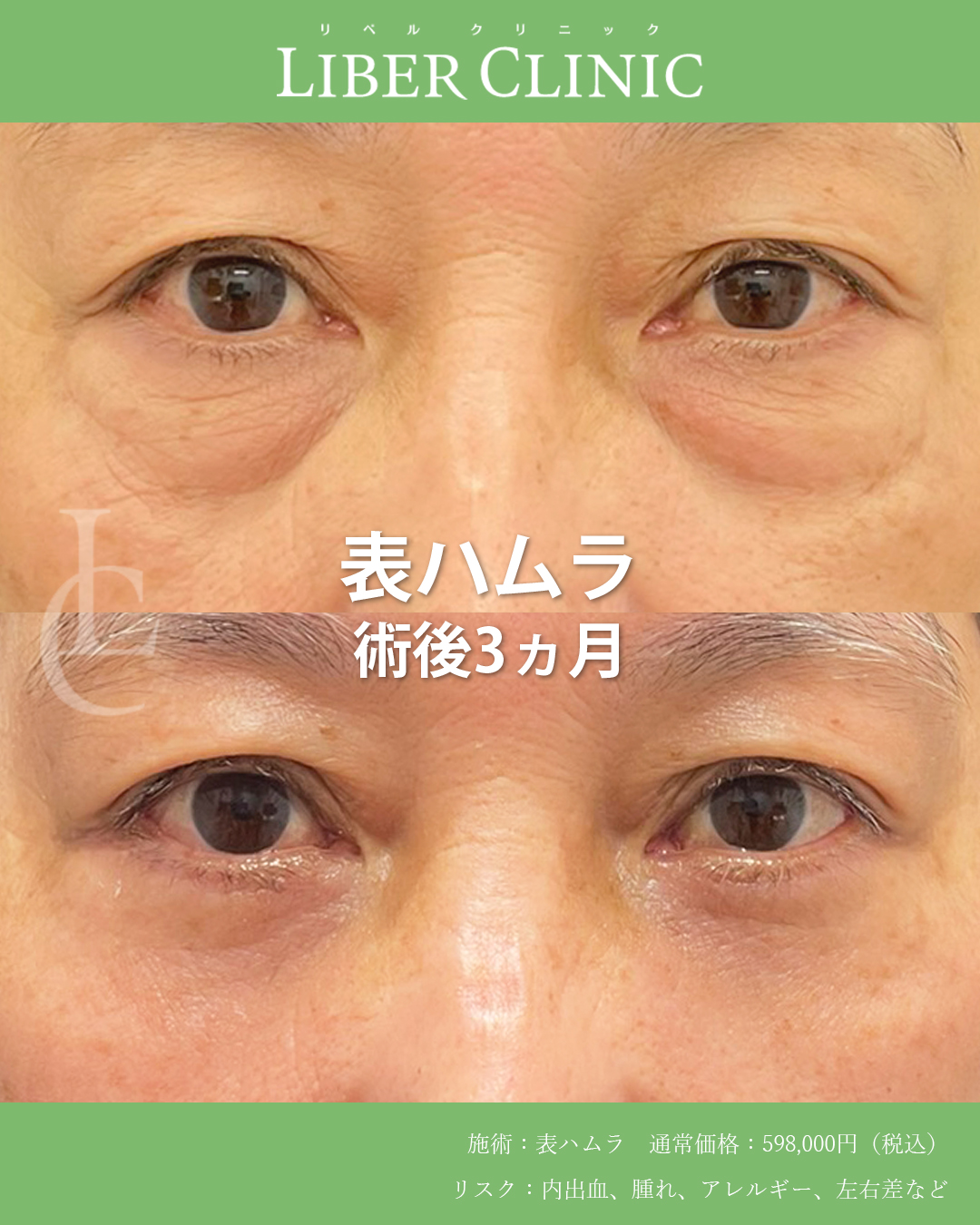 クマもたるみもない 若々しい目元へ