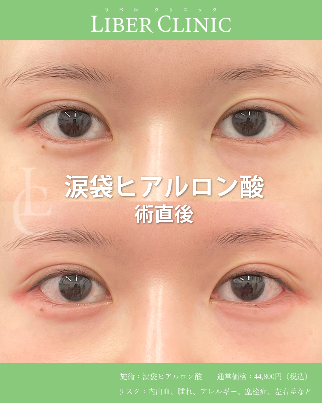 さりげなく整える涙袋の左右差