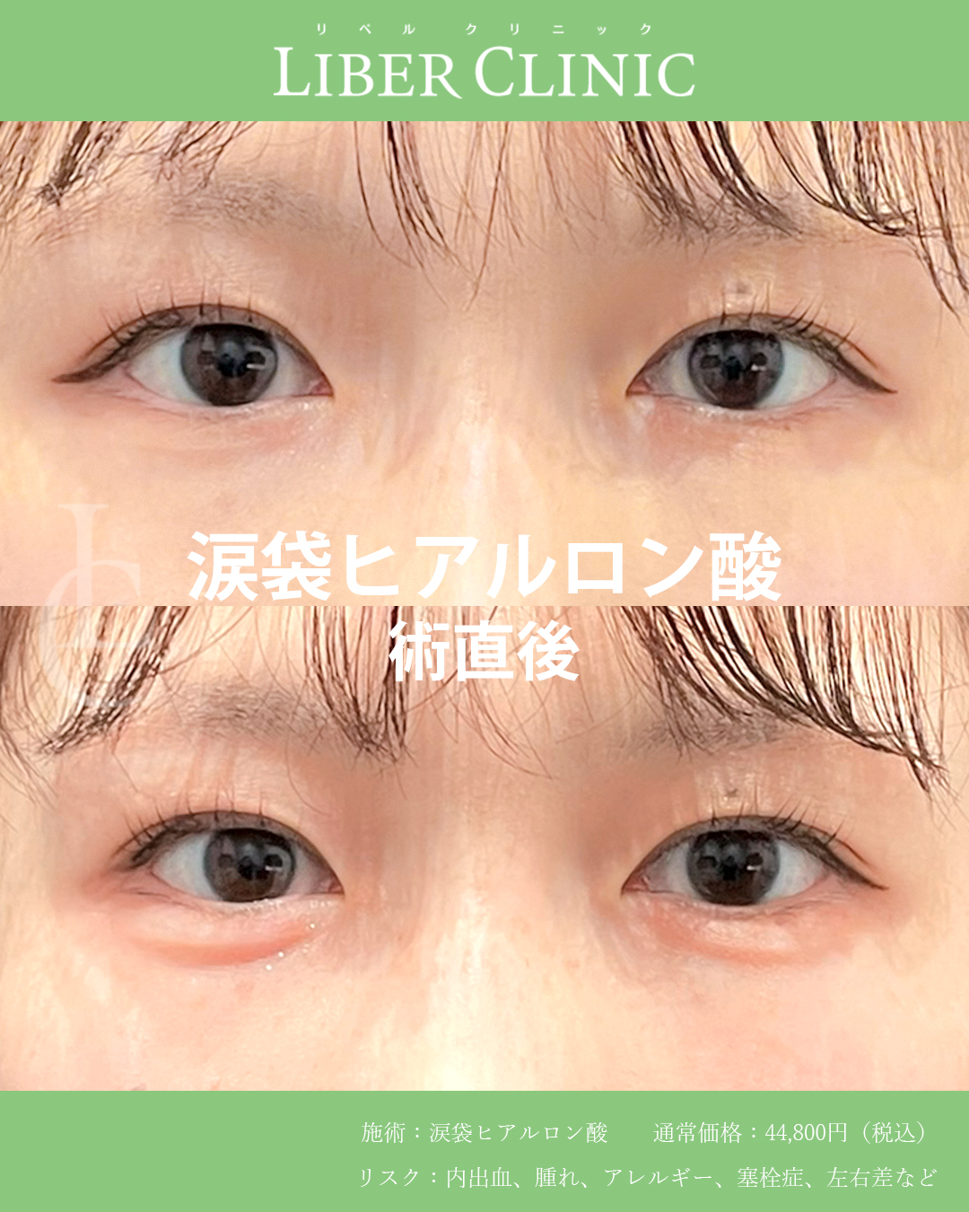 目元の余白に可愛さをプラス