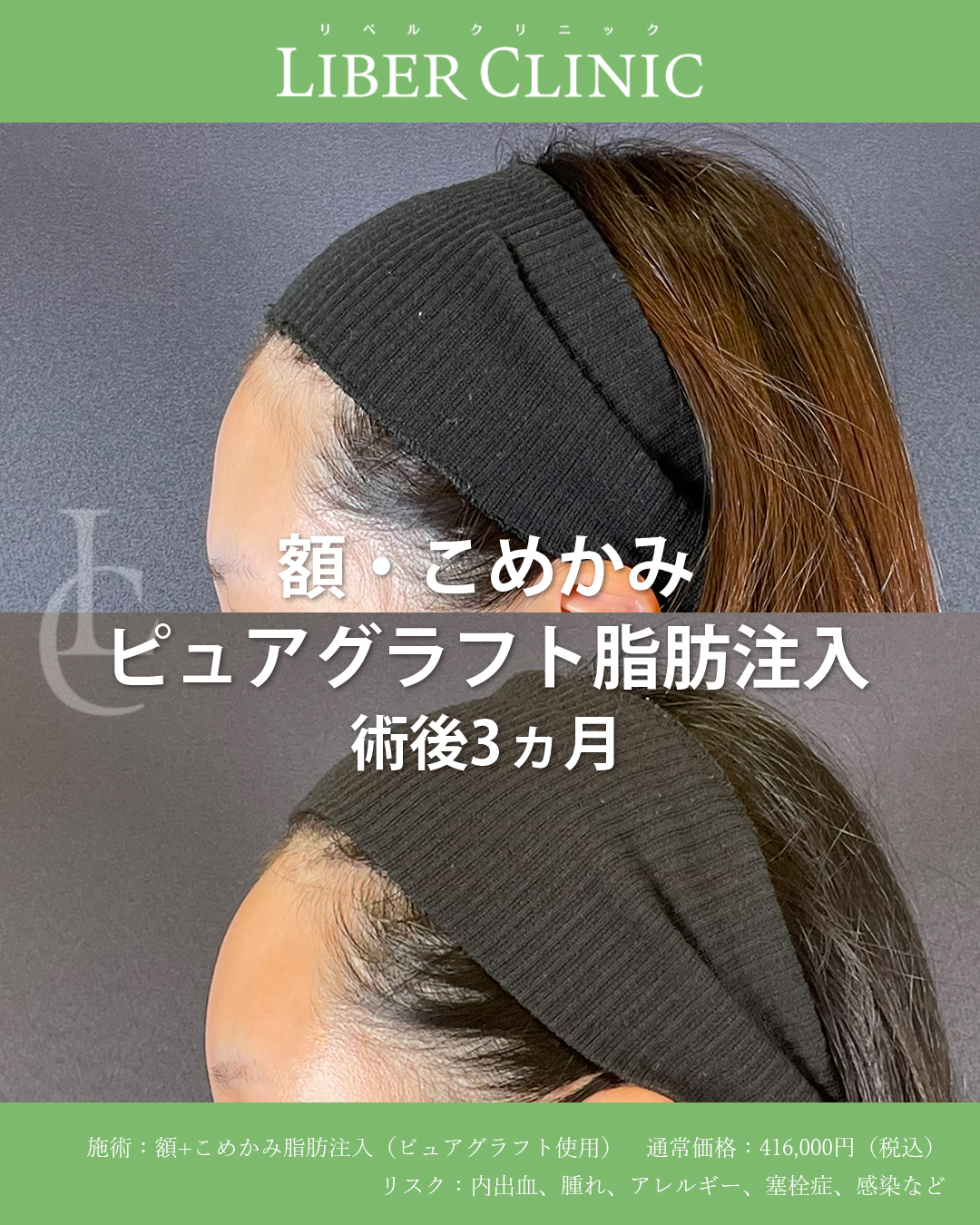 “自然な丸み”だけを足すピュアグラフト脂肪注入